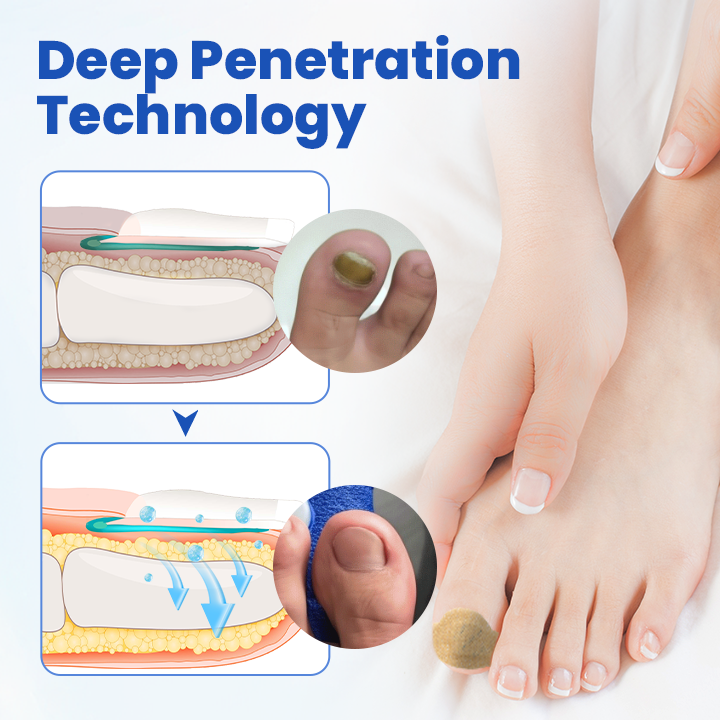 FungalPatch - Antibacterial Fungal Patch